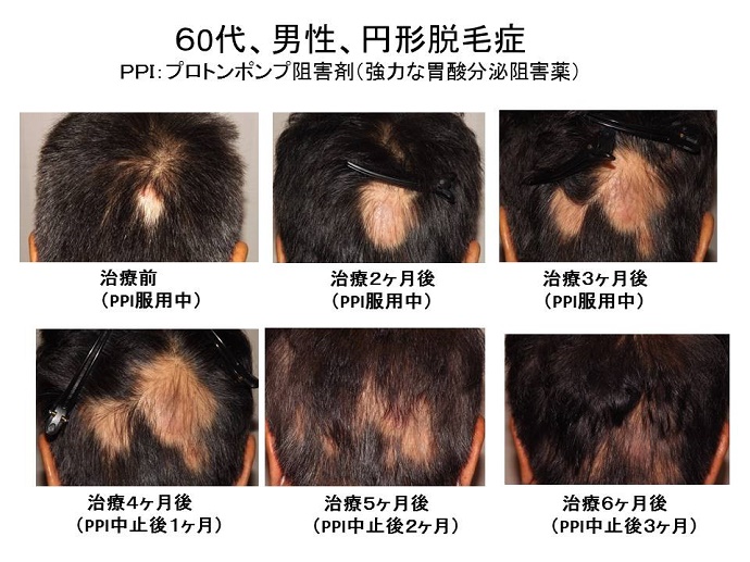 円形脱毛症　病院""